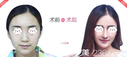 做膨体隆鼻术后60天的恢复效果