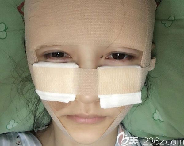 面部自体脂肪填充第2天没有发现创伤和切口