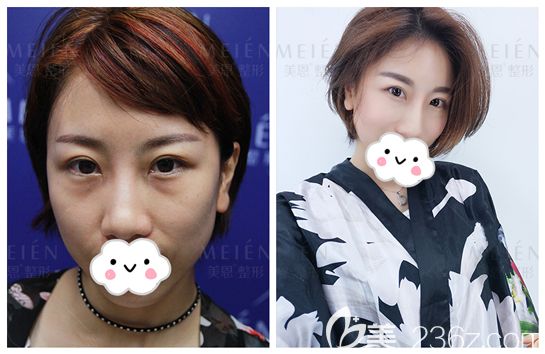 陈宏斌开运鼻整形术后50天案例对比