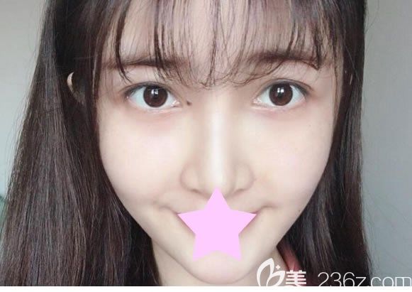 全面部填充七天脸上的注射针眼已经结痂