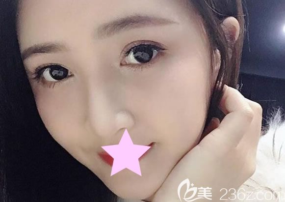 自体脂肪面部填充一个月恢复效果图