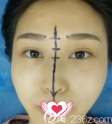 巧致整形医院任加伟医生做假体隆鼻前鼻子塌平 巧致整形医院任加伟医生做假体隆鼻前鼻子塌平