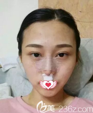 任加伟医生为我刚做完隆鼻术后鼻子微肿 任加伟医生为我刚做完隆鼻术后鼻子微肿