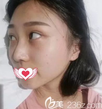 在秦皇岛巧致做假体隆鼻术后7天进行拆线 在秦皇岛巧致做假体隆鼻术后7天进行拆线