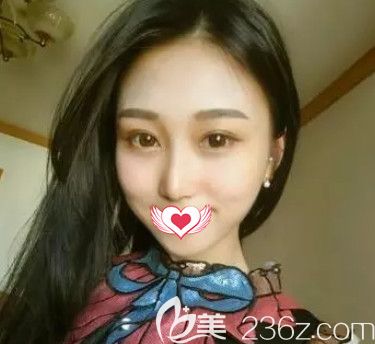 任加伟医生为我做硅胶隆鼻18天鼻子完全消肿 任加伟医生为我做硅胶隆鼻18天鼻子完全消肿