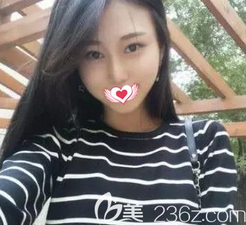 在秦皇岛巧致做完硅胶隆鼻术后1个月 终于拥有我梦寐以求的高挺俏丽自然鼻
