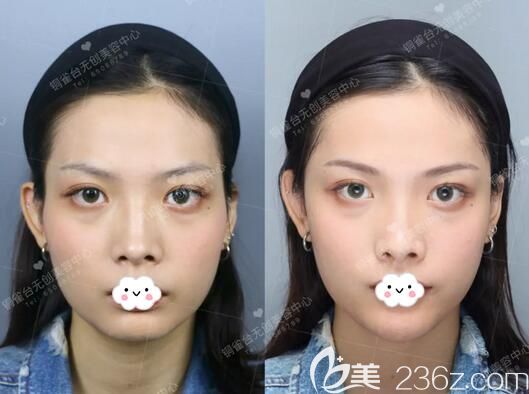 玻尿酸丰太阳穴术后正面对比 玻尿酸丰太阳穴术后正面对比