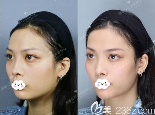 玻尿酸填充下巴术后侧脸对比 玻尿酸填充下巴术后侧脸对比