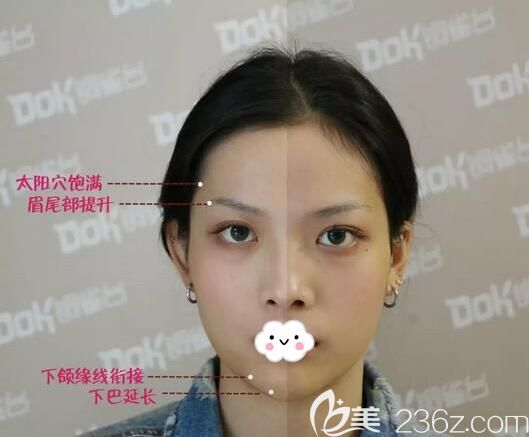 玻尿酸填充太阳穴、下巴半边脸对比 玻尿酸填充太阳穴、下巴半边脸对比