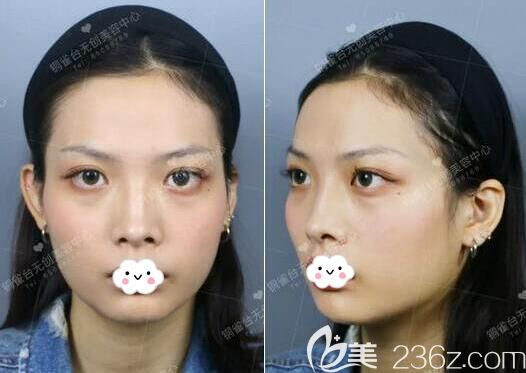 注射玻尿酸塑形前的照片 注射玻尿酸塑形前的照片