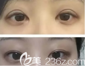 荣成威海孙漫整形诊所双眼皮案例 荣成威海孙漫整形诊所双眼皮案例