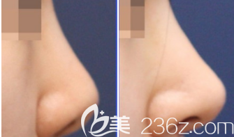 荣成威海孙漫整形诊所隆鼻案例 荣成威海孙漫整形诊所隆鼻案例