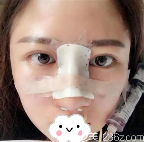 成都铜雀台<!--<i data=20240703-sp></i>-->隆鼻术后即刻