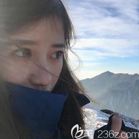 肋软骨隆鼻术后2个月美照