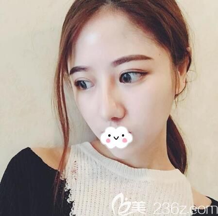 成都铜雀台<!--<i data=20240703-sp></i>-->肋软骨鼻综合术后一年