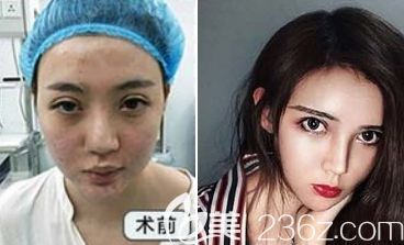 自体脂肪填充案例