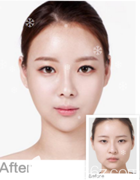 威海威高梨花医疗美容医院双眼皮+吸脂案例