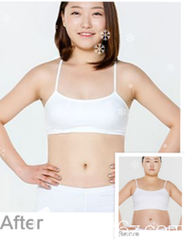 威海威高梨花医疗美容医院全身吸脂案例