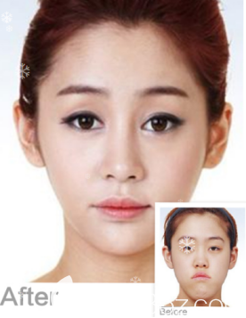 威海威高梨花医疗美容医院下颌角轮廓+眼鼻案例