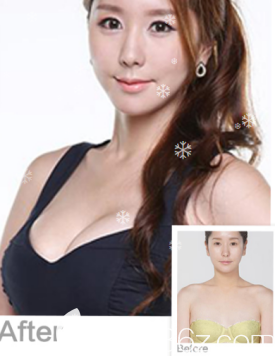 威海威高梨花医疗美容医院假体隆胸案例