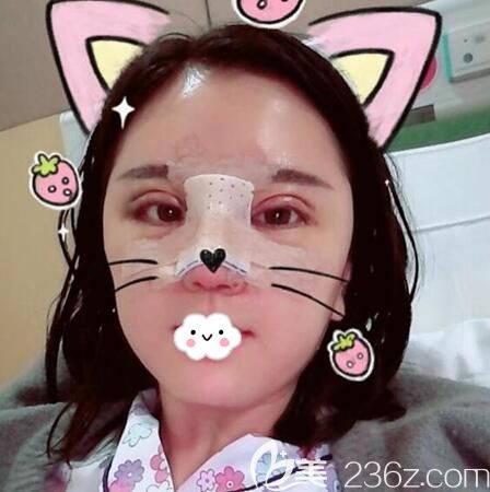 眼综合鼻综合术后即刻