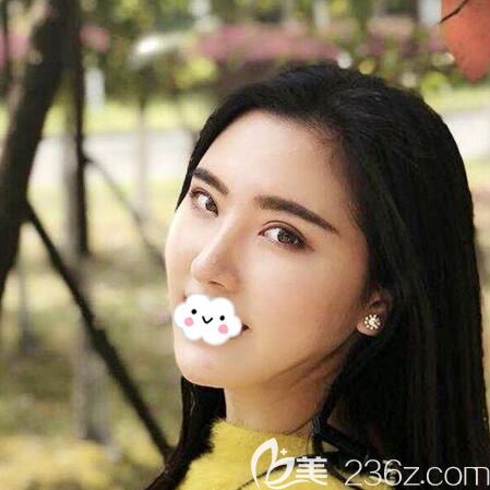 杨建双眼皮隆鼻术后半年美照