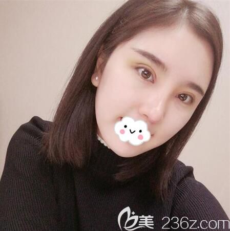 杨建双眼皮术后7天恢复效果