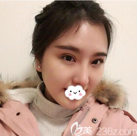 全切双眼皮术后3个月效果