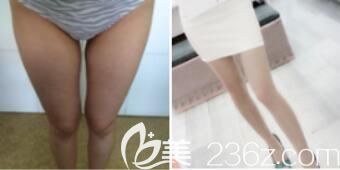 上海仁爱医院整形美容科刘建国大腿吸脂真人案例
