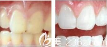 医院整形美容科李育林冷光牙齿美白 医院整形美容科李育林冷光牙齿美白