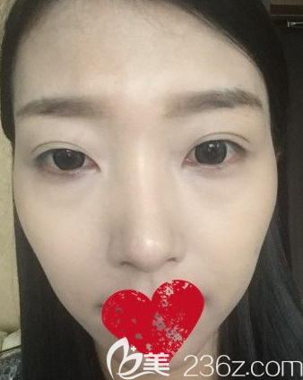 沈明自体脂肪填充面部术前照片