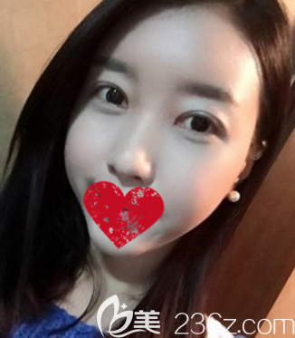 沈明自体脂肪填充一周后的样子