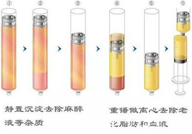 自体脂肪优化分离图