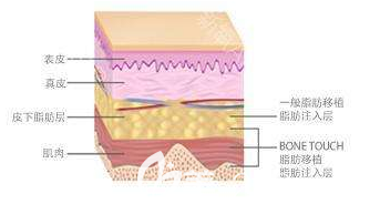 自体脂肪作用在皮肤的部位示意图
