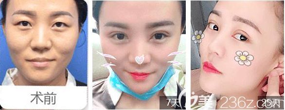 常州美贝尔双眼皮<span style= 常州美贝尔双眼皮<span style=