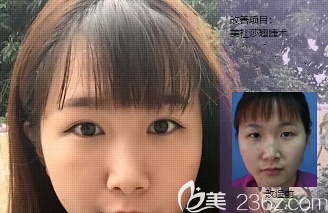 王主任做埋线双眼皮的手术案例