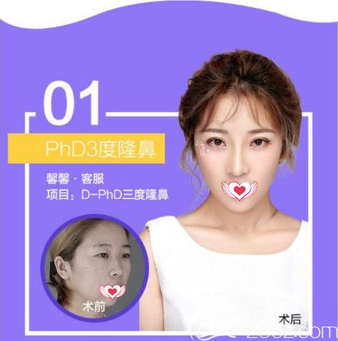 蔡鹏武院长做鼻综合案例 蔡鹏武院长做鼻综合案例