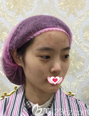 韦杰医生做隆鼻术前鼻子塌平 韦杰医生做隆鼻术前鼻子塌平