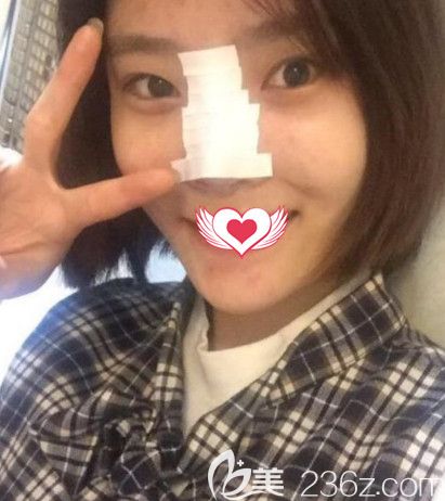 在<!--<i data=20240703-sp></i>-->做隆鼻术后鼻子微肿 在<!--<i data=20240703-sp></i>-->做隆鼻术后鼻子微肿