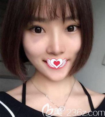 韦杰医生为我做假体隆鼻术后16天鼻子消肿 韦杰医生为我做假体隆鼻术后16天鼻子消肿