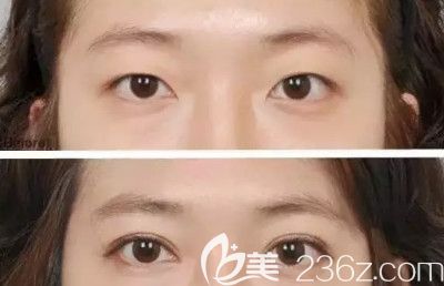 做双眼皮案例 做双眼皮案例