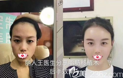 2019年春节到邯郸丽人有超多整形优惠 做双眼皮、隆鼻和脂肪填充价格全部打5折