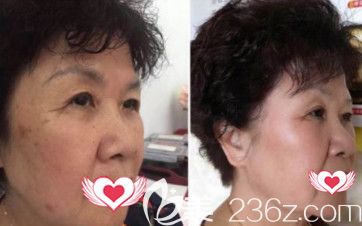 邯郸都市激光祛斑案例 邯郸都市激光祛斑案例