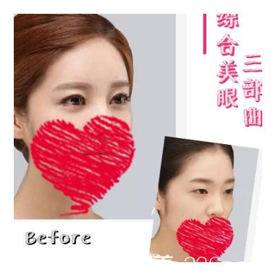 无锡施尔美双眼皮案例 无锡施尔美双眼皮案例