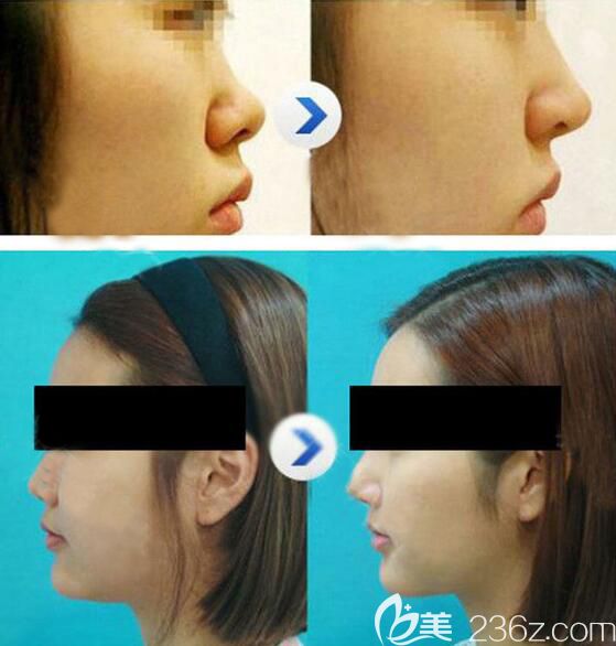 无锡施尔美小翘鼻对比效果 无锡施尔美小翘鼻对比效果