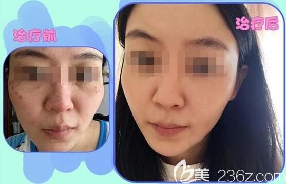 无锡施尔美祛斑效果 无锡施尔美祛斑效果