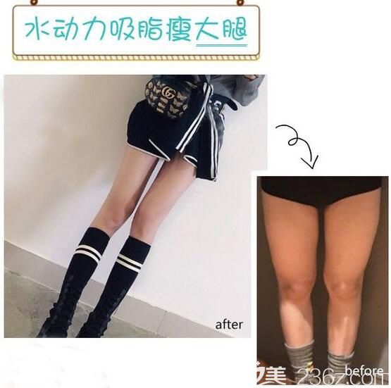 无锡施尔美水动力吸脂 无锡施尔美水动力吸脂