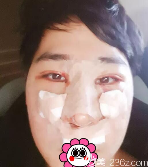 在韩国BK整形找李丙濬院长做眼鼻整形术后 在韩国BK整形找李丙濬院长做眼鼻整形术后