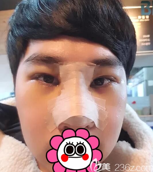 逐渐消肿的双眼皮+鼻部整形 逐渐消肿的双眼皮+鼻部整形