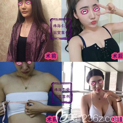 珠海仁爱艾先新隆胸对比图 珠海仁爱艾先新隆胸对比图